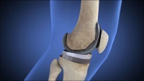 骨性关节炎 手可以感觉到磨擦感 听到再晚需要关节置换 吓懵