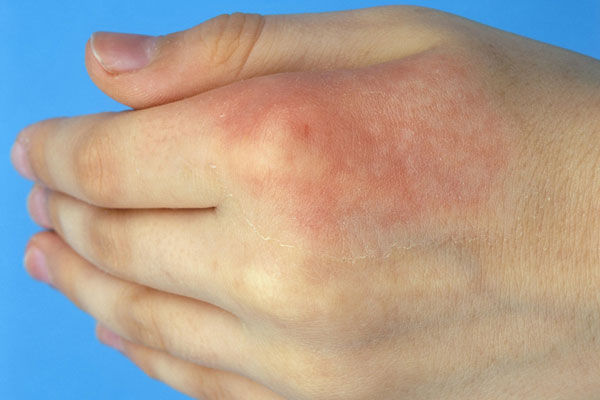 谣言第92期:烫伤后抹牙膏不留疤?